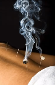 Acupuncture at Body Wise Therapy in Leeds