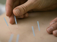 Acupuncture at Body Wise Therapy in Leeds